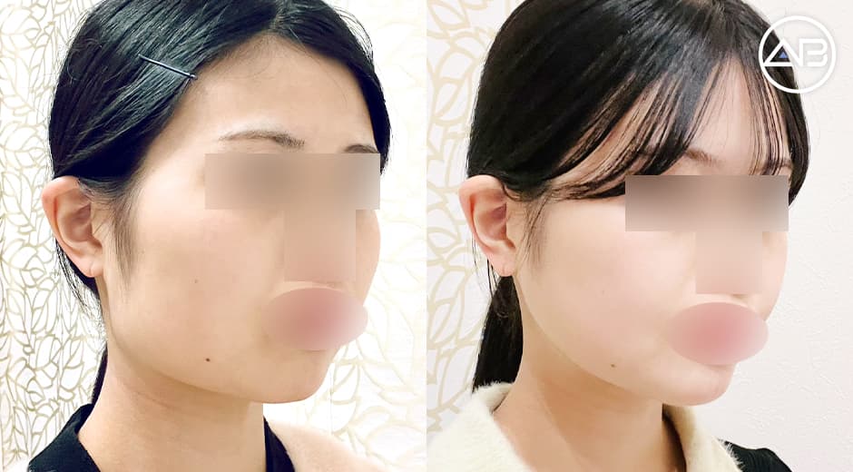 輪郭3点と脂肪吸引から約2ヶ月後のレポです！