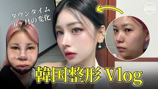 韓国整形のリアルな変化｜ダウンタイム6ヶ月のビフォーアフター | AB美容整形