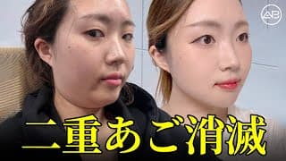 たった1回で二重あごが激変!? 韓国整形リアルレビュー | AB美容整形