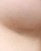 手術2ヵ月後
 乳房下縁切開