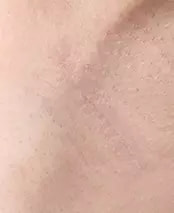 手術2ヵ月後の脇