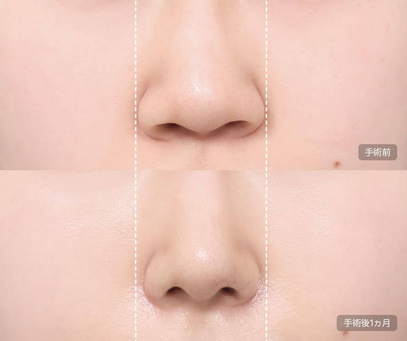Alar Resection