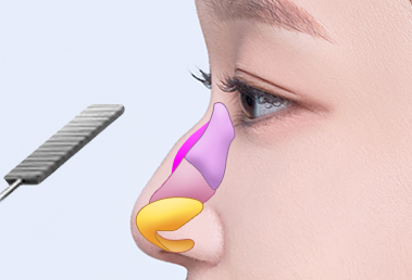 Low hump nose surgery — step 1