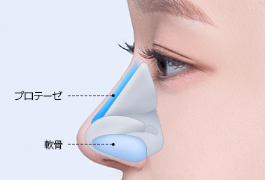 Low hump nose surgery — step 2