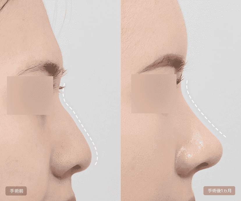 Implant-free Rhinoplasty