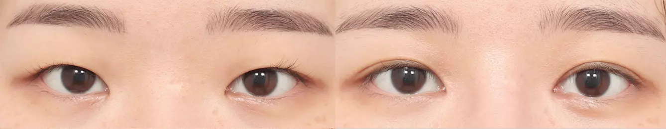 Eye line before and after case 1