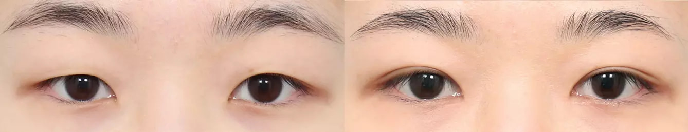 Double eyelid before and after case 1
