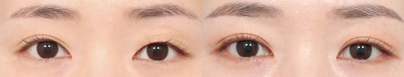 Double eyelid before and after case 2