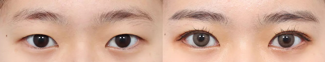 Double eyelid before and after case 3