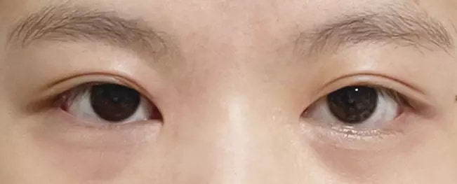 Long lasting before after case 3