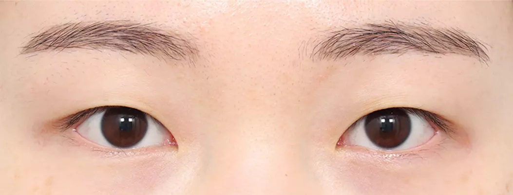 Before natural adhesion surgery