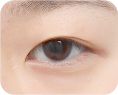 眼瞼下垂がある場合