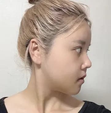 施術12日目