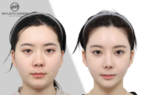 頬骨削は後悔するのか頬のたるみが起きる原因と正しい対処法