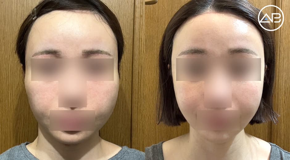 AB美容外科で手術をして1ヶ月が経過しました!