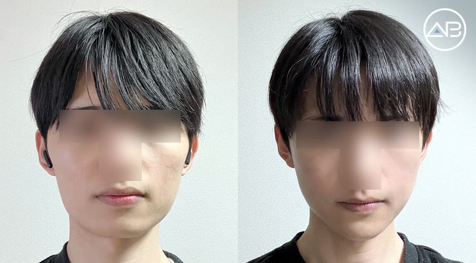 輪郭手術3カ月後の体験記