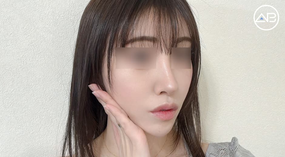 輪郭+鼻+目手術3カ月後の体験記