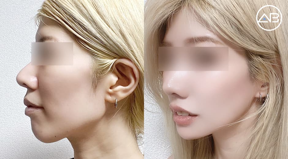 面長卒業!Eラインが綺麗と褒められるようになった輪郭3点リアルレポ✨
