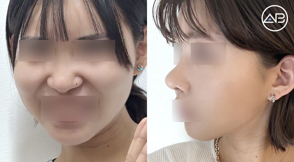 輪郭3点・鼻フル・額縮小+こめかみ脂肪注入の施術レビュー
