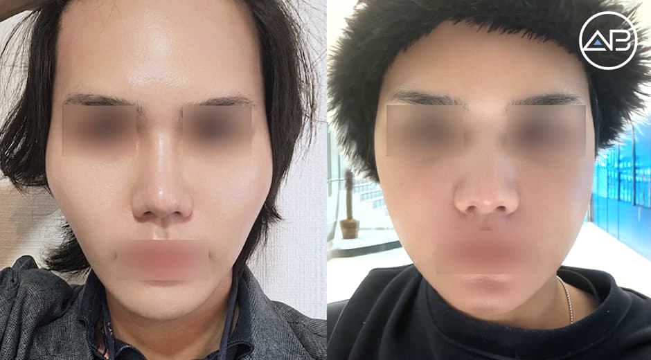 問い合わせ対応から術後ケアまで信頼できたAB美容外科
