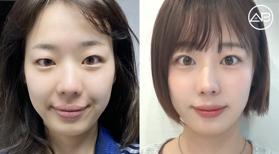 自然癒着二重…仕上がりに大満足