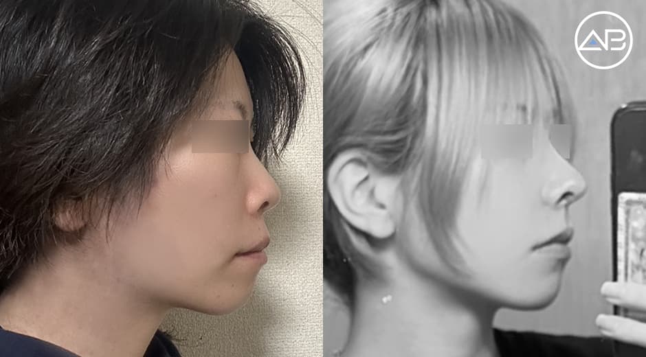 低い鼻・大きな小鼻が気になっていた私の鼻整形
