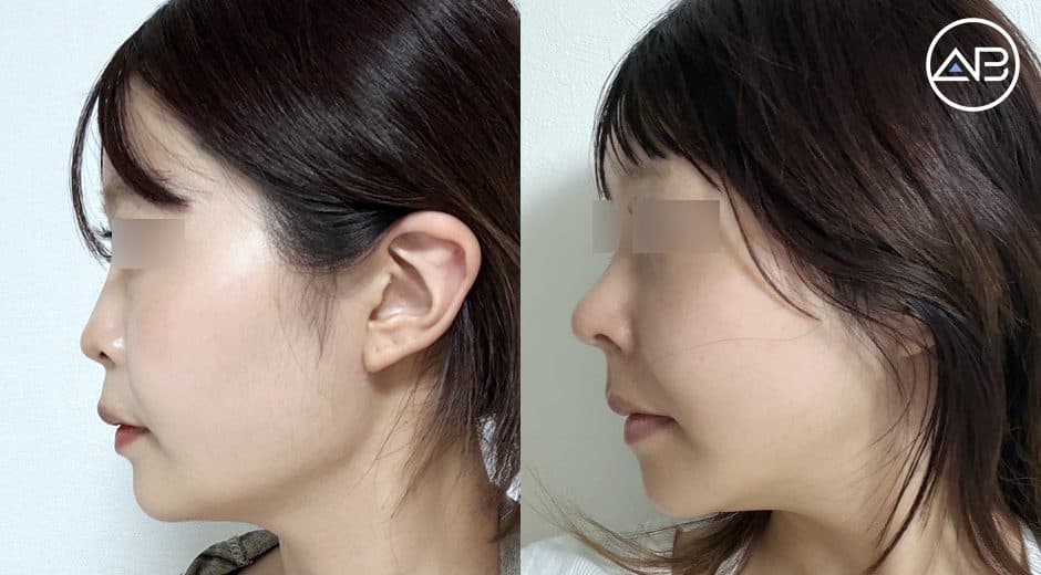 整形感のない自然な変化を目指して|輪郭3点・鼻・脂肪移植