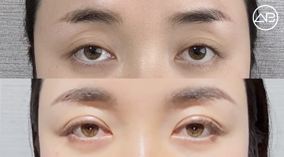 眼瞼下垂手術とまぶたの脂肪注入|術後1ヶ月の経過と満足度