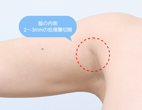 Minimal 2 to 3 mm incision on the inner armpit