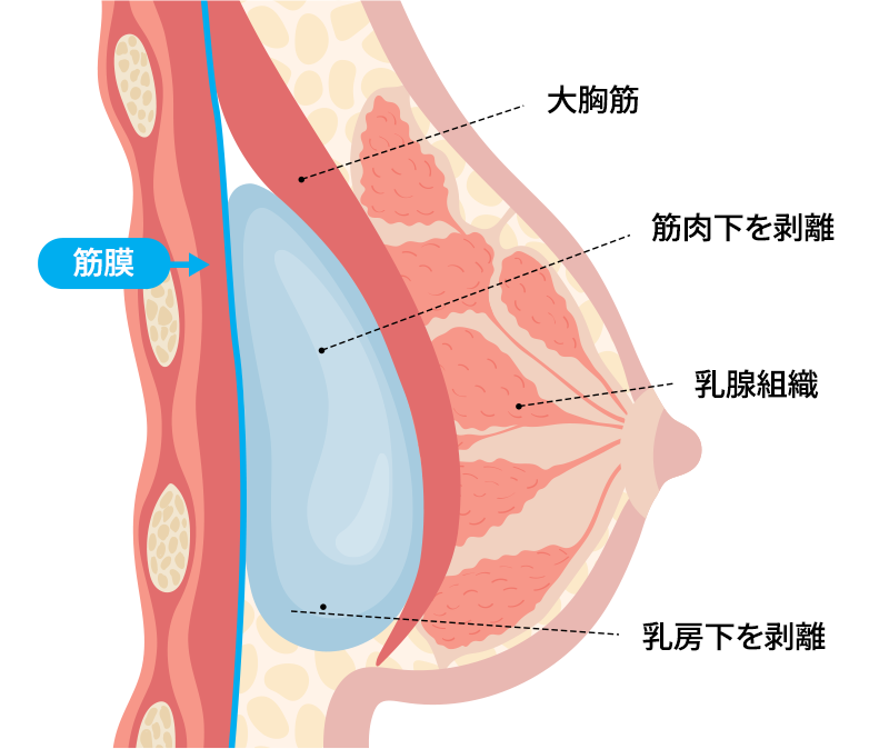 デュアルプレーン法