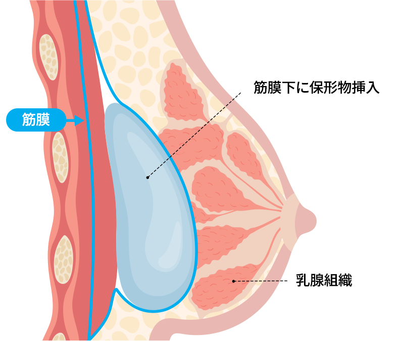 筋膜下挿入法