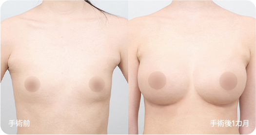 Ab Surgery