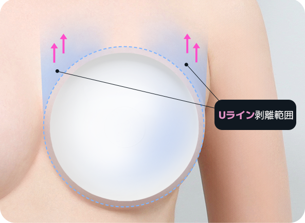 Ab Surgery
