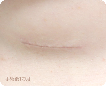 Ab Surgery