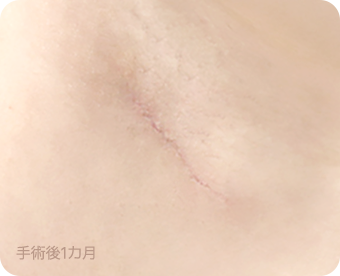 Ab Surgery