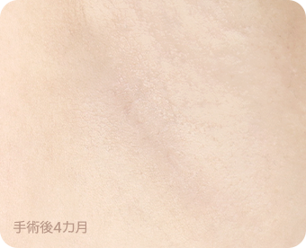 Ab Surgery