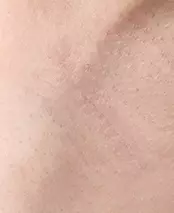 手術2ヵ月後
 脇切開