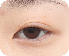 眼瞼下垂がある場合