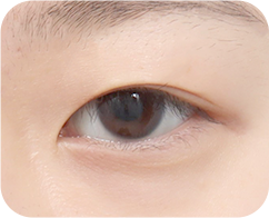 眼瞼下垂がある場合