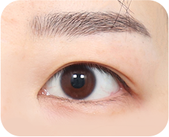 眼瞼下垂がある場合