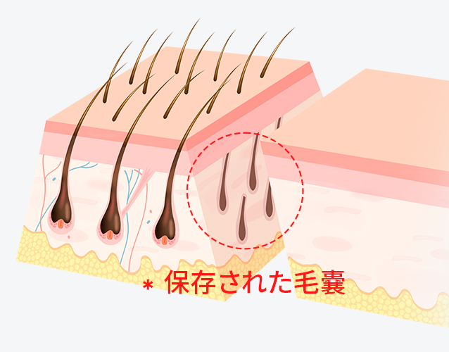 45度斜線切開で毛嚢保存