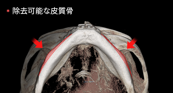 正面効果のため皮質骨切除