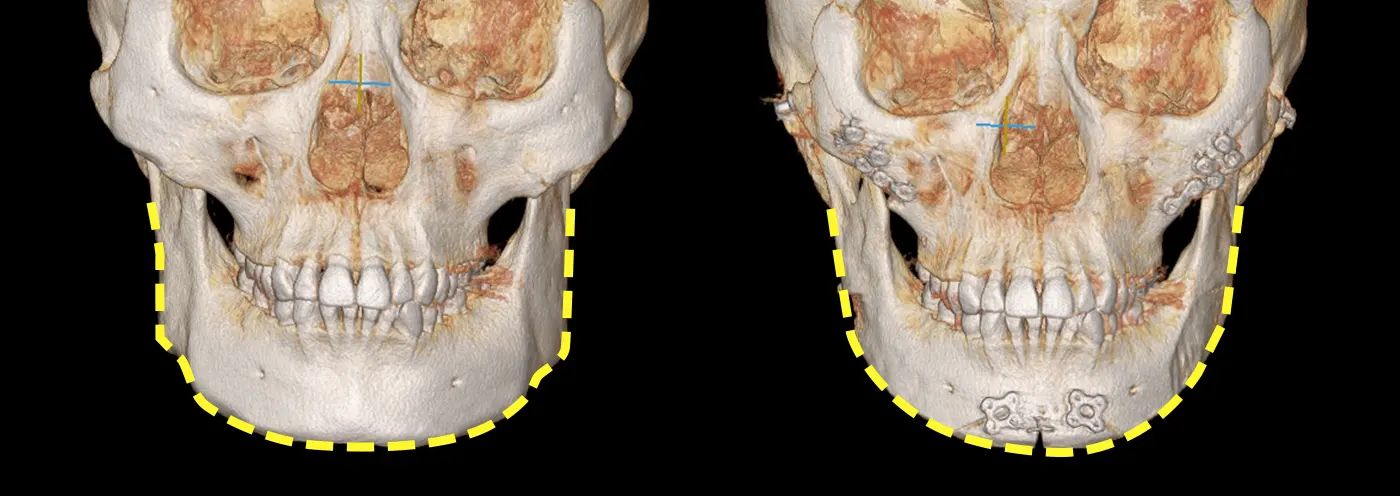 맥미걸 악플콜렉터 수술 전후 ct 사진
