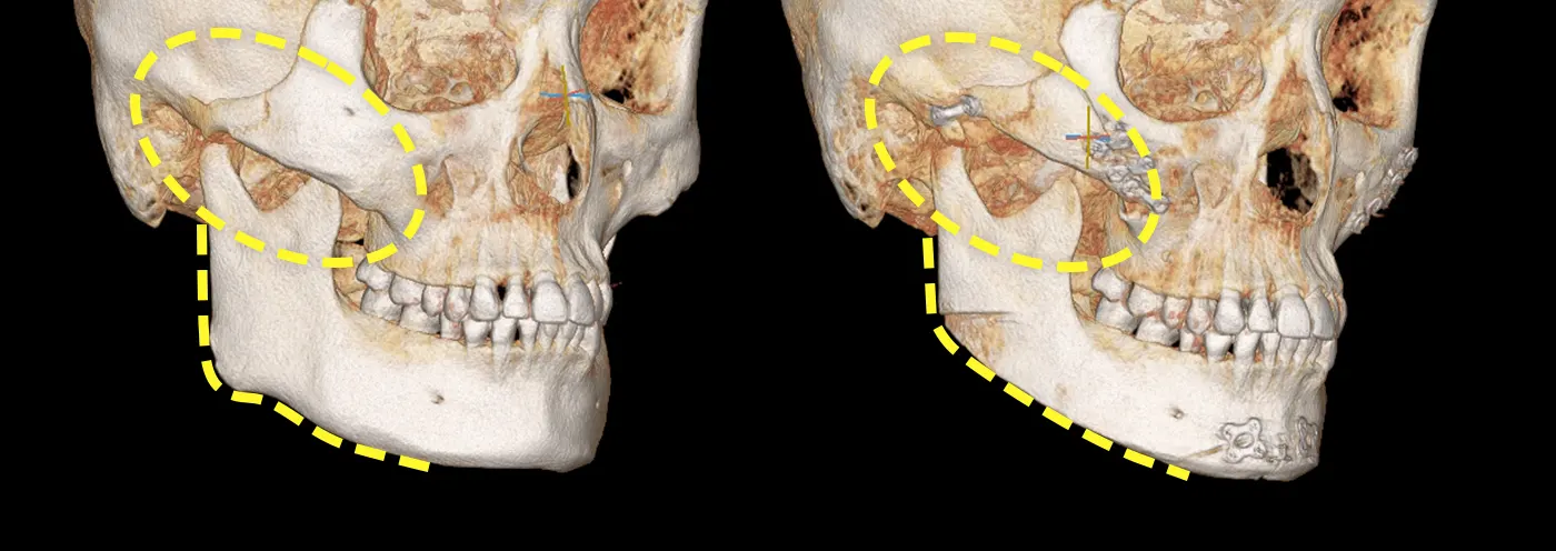 맥미걸 악플콜렉터 수술 전후 ct 사진