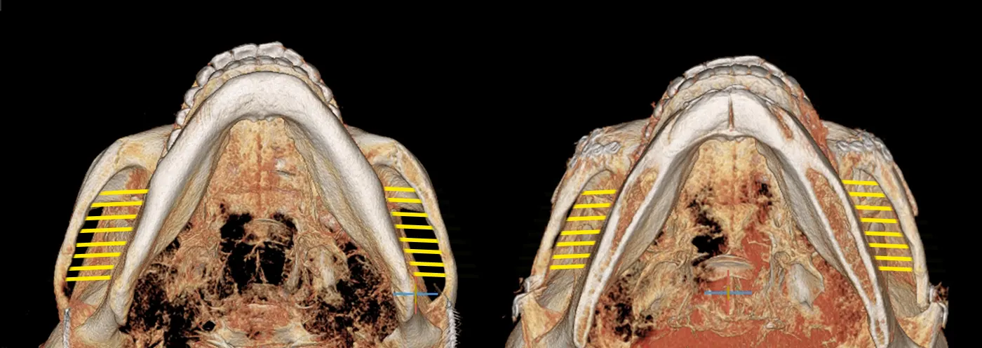 맥미걸 악플콜렉터 수술 전후 ct 사진