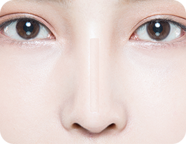 revision-rhinoplasty