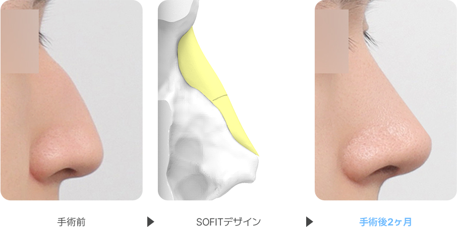 Severe Hump case