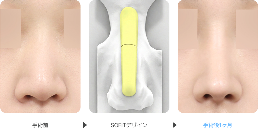 Deviated Nose case