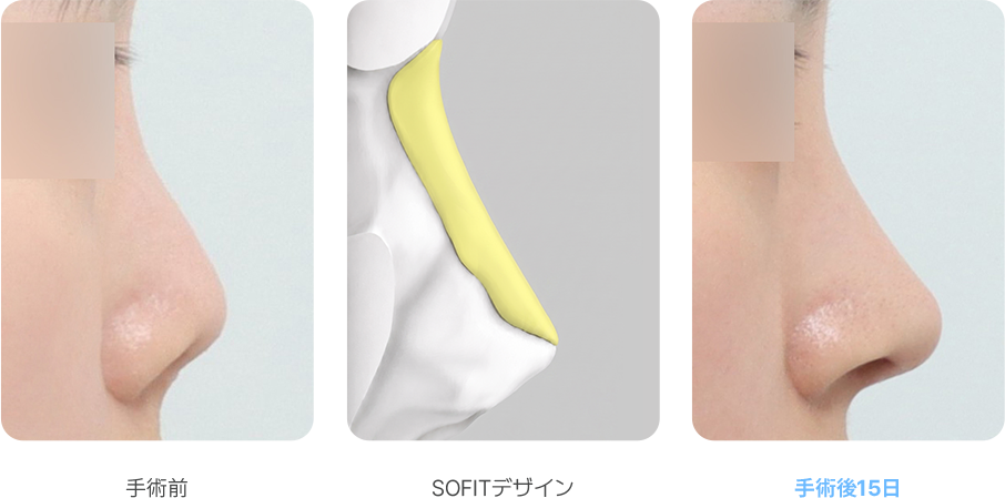 Contracted Nose case