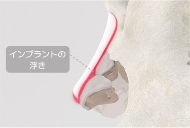 普通の鼻整形